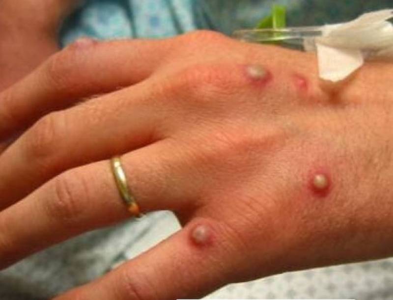 <span style='color:#780948'>ARCHIVED</span> - First case of monkeypox confirmed in Region of Murcia